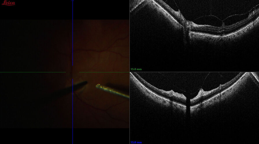 CENTOGENE Intraoperative OCT image showing retinal detachment