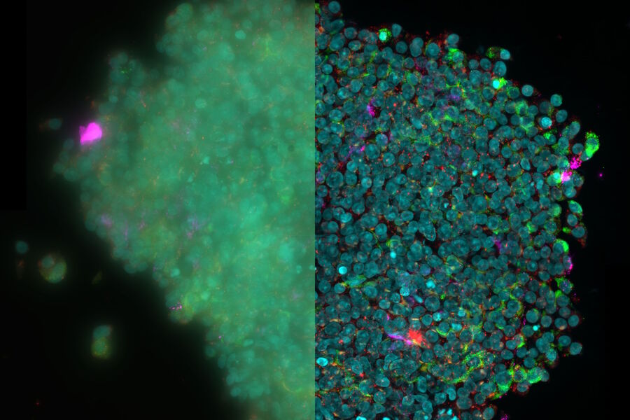 EDoF reconstruction of an isolated human islet to experimentally examine the expression of IL-17, a proinflammatory cytokine, in individual human islet cells. The images have the following markers: Insulin (AF488; green), Glucagon (AF555; red) and IL-17 (AF647; magenta) and Hoechst (nuclei; blue). Image courtesy of the Matthias Von Herrath Lab at the La Jolla Institute of Immunology, La Jolla, CA., USA.