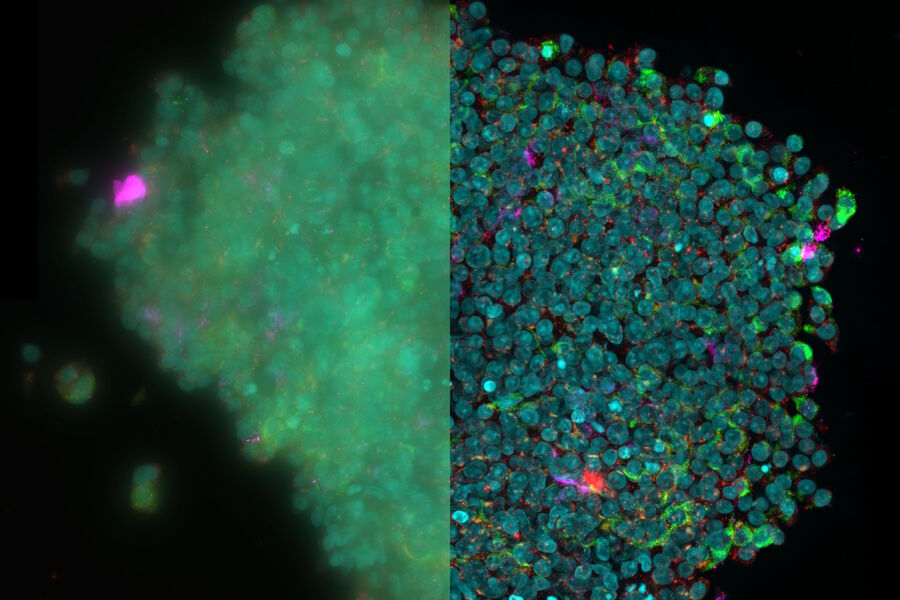 EDoF reconstruction of an isolated human islet EDoF reconstruction of an isolated human islet to experimentally examine the expression of IL-17, a proinflammatory cytokine, in individual human islet cells. The images have the following markers: Insulin (AF488; green), Glucagon (AF555; red) and IL-17 (AF647; magenta) and Hoechst (nuclei; blue). Image courtesy of the Matthias Von Herrath Lab at the La Jolla Institute of Immunology, La Jolla, CA., USA.