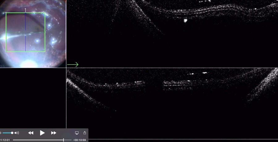 [Translate to chinese:] Vitrectomy for retinal detachment with use of PFCL shows macular detachment during the PFCL-air exchange.