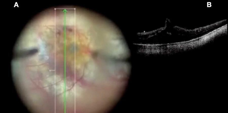 Vitrectomy and ILM peeling in macular hole in a high myopic eye.
