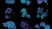Fixed patient-derived neuroendocrine tumor organoids labeled with DAPI (cyan) and phalloidin (magenta), imaged using Viventis SCAPE; scale bar 50μm. Courtesy of Marina Cuenca and Heleen Jungen (Dayton lab), EMBL Barcelona.