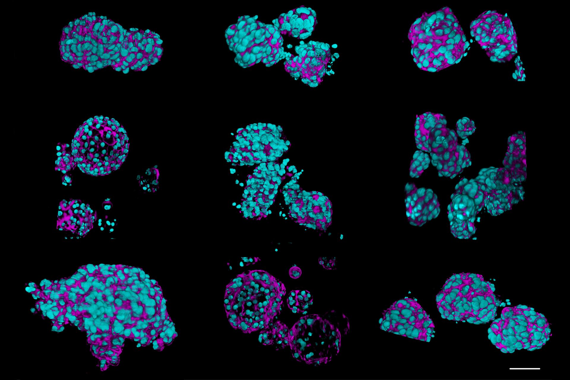 Fixed patient-derived neuroendocrine tumor organoids labeled with DAPI (cyan) and phalloidin (magenta), imaged using Viventis SCAPE; scale bar 50μm. Courtesy of Marina Cuenca and Heleen Jungen (Dayton lab), EMBL Barcelona.
