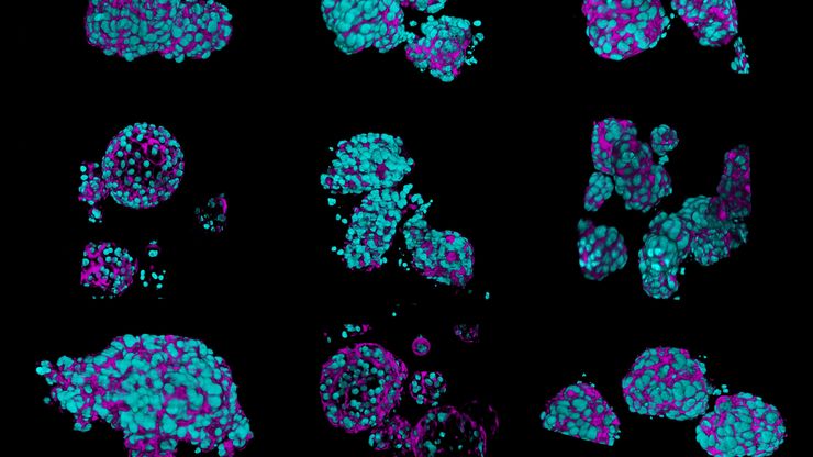 Fixed patient-derived neuroendocrine tumor organoids labeled with DAPI (cyan) and phalloidin (magenta), imaged using Viventis SCAPE; scale bar 50μm. Courtesy of Marina Cuenca and Heleen Jungen (Dayton lab), EMBL Barcelona.