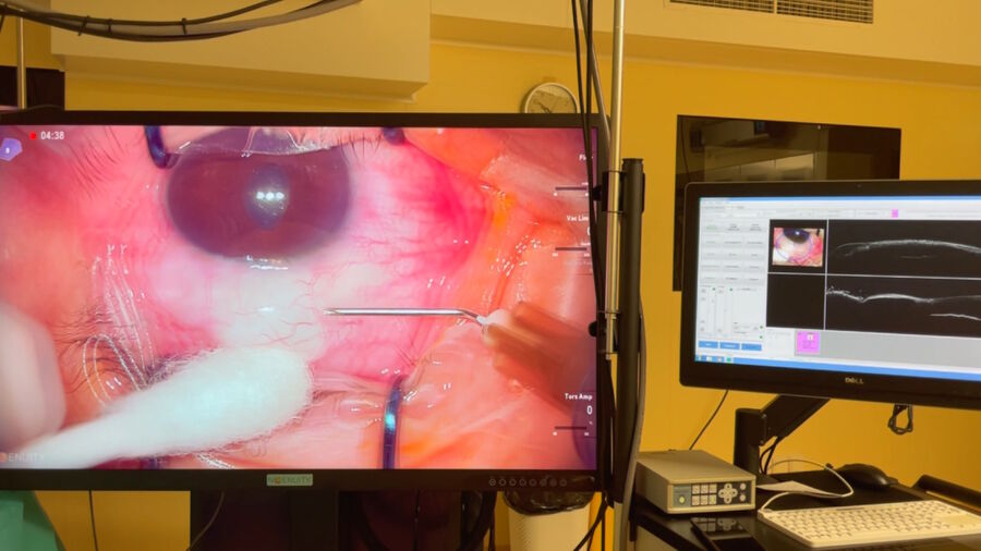 Surgery is displayed on a 3D visualization system screen, with support from intraoperative OCT to visualize the two different planes. Image courtesy of Dr. Ozana Moraru.