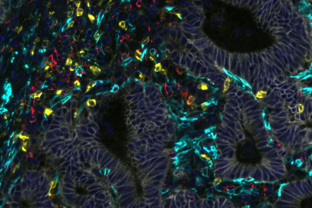 Colon Adenocarcinoma. Four biomarkers shown: NaK, CD8, CD4 and Sma1. T-Cells shown in red and yellow.   Colon_adenomacarcinoma_NaK_CD8_CD4_Sma1_DAPI_teaser.jpg