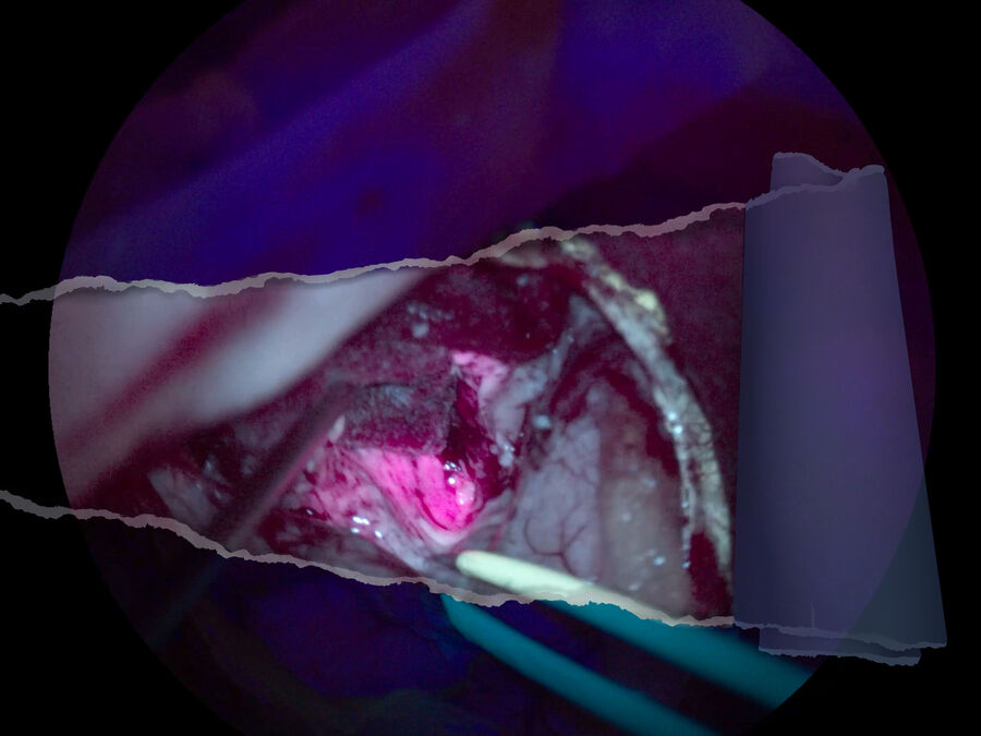 GLOW400 images are courtesy of Tim Jacquesson, MD, PhD Hospices Civils de Lyon, France