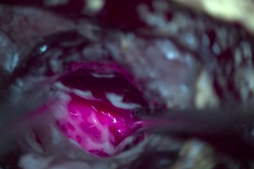 GLOW400 AR Fluorescence in anatomy view, image courtesy of Prof. Kondo Leica_Microsystems_GLOW400_AR_Fluorescence_in_brain_tumor_surgery.jpg