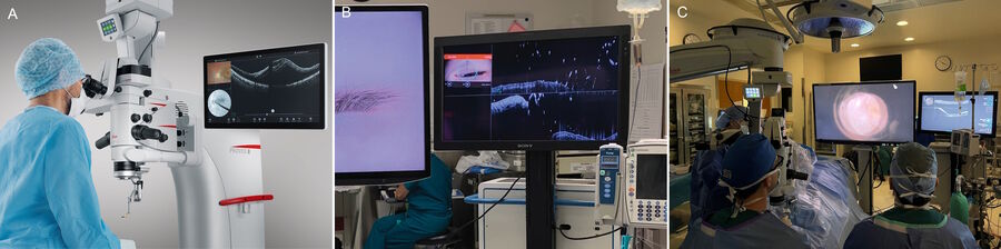 Figure 3: Surgeon and Workflow Arrangements. A) Image injection, B) External Monitor for Intraoperative OCT, C) 3D Visualization system with separate monitor for Intraoperative OCT.