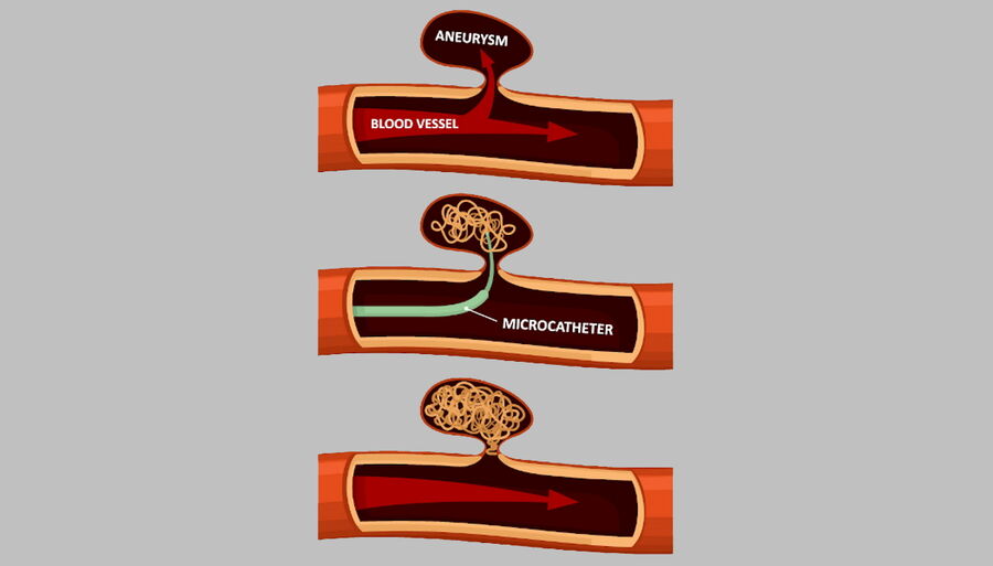 Endovascular treatment of cerebral aneurysms.