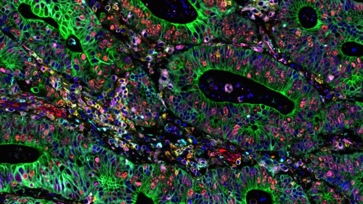 Cell DIVE multiplexed image of FFPE tissue section from human colon adenocarcinoma tissue. Cell DIVE multiplexed image of FFPE tissue section from human colon adenocarcinoma tissue.