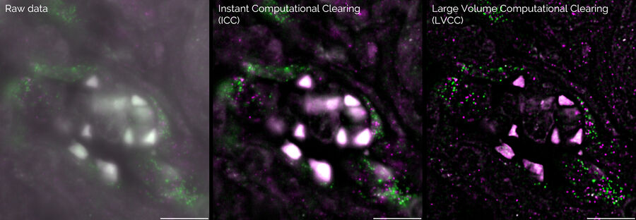 Single molecule RNA-FISH in cancerous tissue. RNA-01 (green), RNA-02 (magenta) Left: Raw data. Middle: With Instant Computational Clearing. Right: After Large Volume Computational Clearing. Courtesy of Prof. Andreas Moor, University of Zurich (Switzerland).