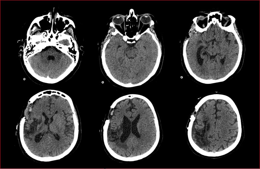 Postoperative MRI scan showing no post-operative complications.