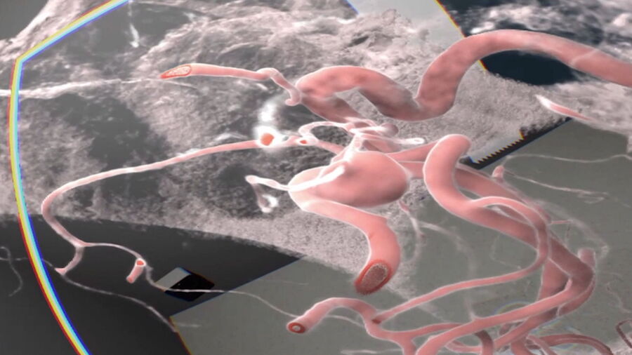 Analysis of an aneurysm with Virtual Reality. Image courtesy of Prof. Raphael Guzman.
