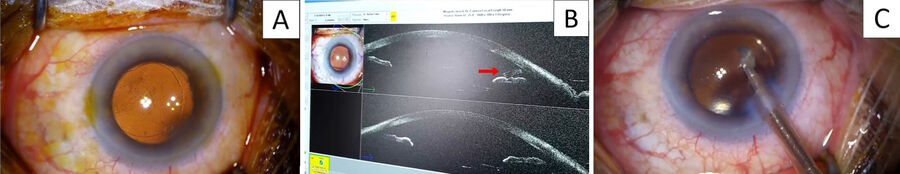 Figure 1: A: At the end of the surgery, I had a doubt about the presence of a residual fragment hidden behind the corneal edema of the main incision. B: Intraoperative OCT was performed; I could clearly identify a residual fragment hidden behind the primary incision (red arrow). C: The residual fragment was quite big and could not disappear with corticotherapy alone.