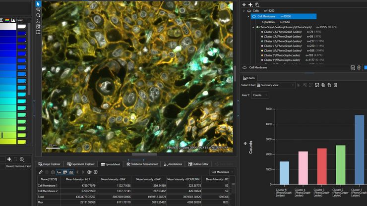 Pancreatic ductal cancer tissue section by Melinda Hill, Ph.D., Leica Microsystems