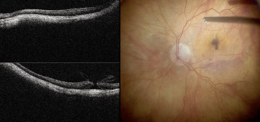 Fig. 4: The intraoperative OCT is showing in detail that macular hole is nearly closed and ILM flap is in the right place.