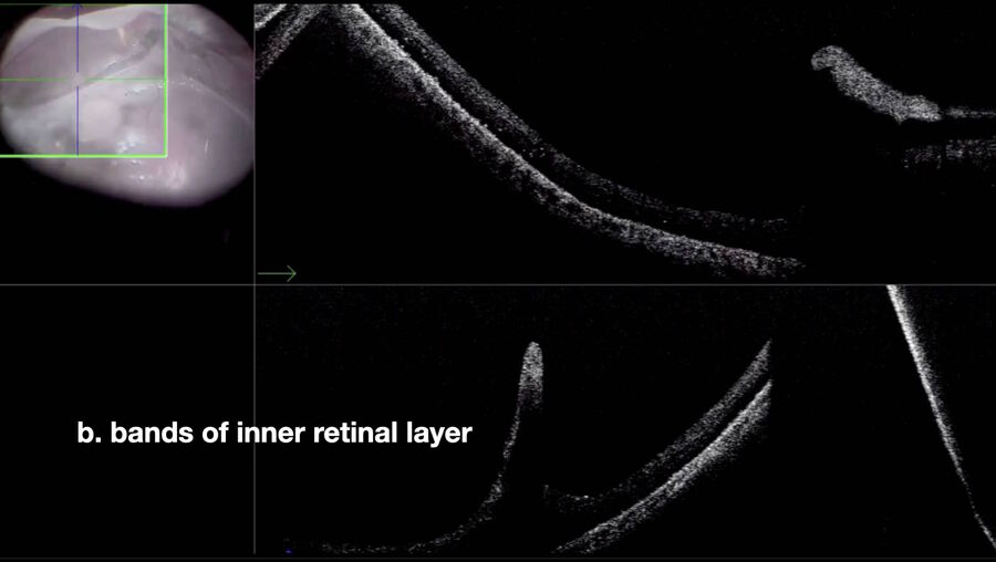 OCT shows that point “b” are bands of the inner retinal layer.