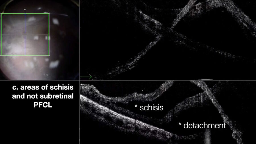 OCT shows that point “c” represents areas of schisis and not subretinal PFCL.