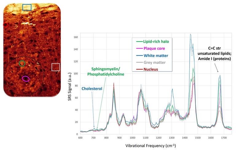 Las imágenes espectroscópicas SRS proporcionan información detallada sobre la composición química de las estructuras cerebrales. Izquierda: Imagen de SRS que muestra estructuras de materia blanca ricas en lípidos sanas (arriba) y depósitos lipídicos patológicos alrededor de una placa de β amiloide (abajo a la izquierda). Derecha: Los espectros SRS muestran que los depósitos patológicos están enriquecidos con lípidos de membrana (sofingomyelina, fosfatidilcolina) en comparación con la materia blanca más rica en colesterol.