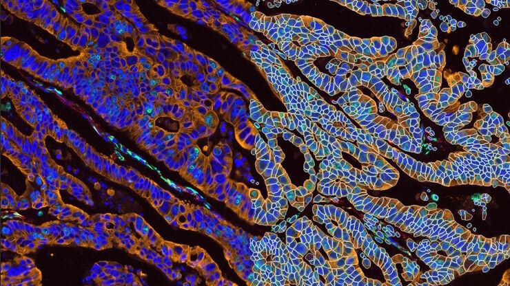 Image caption: A panel of approximately 30 biomarkers targeted towards various leukocyte lineages, epithelial, stromal, and endothelial cell types was utilized to characterize the tumor microenvironment in human colon adenocarcinoma (CAC) tissue. Image shown displays multiple markers including PANCK, EPCAM, NaK, Vimentin, Ki67, SURV, and DAPI.