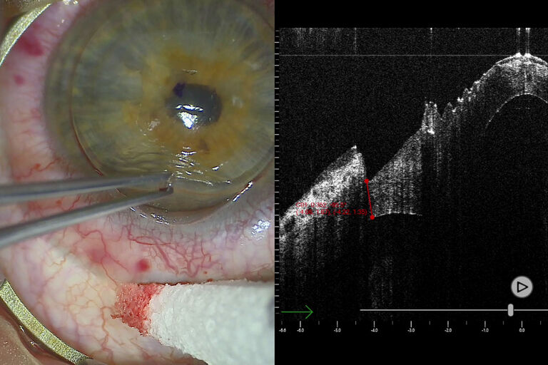 As medições com o tomógrafo de coerência óptica intraoperatório EnFocus durante uma cerotoplastia lamelar anterior profunda para cerotocone ajudam a quantificar a profundidade da incisão. Cortesia de Enrico Bertelli MD, Chefe do Departamento de Oftalmologia, Bolzano Hospital, Itália