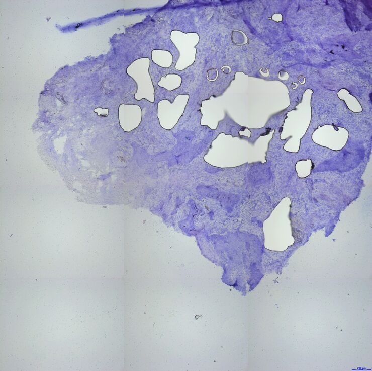 Exemplary Specimen Overviews of a customer sample with many tumor areas being dissected Exemplary Specimen Overviews of a customer sample with many tumor areas being dissected