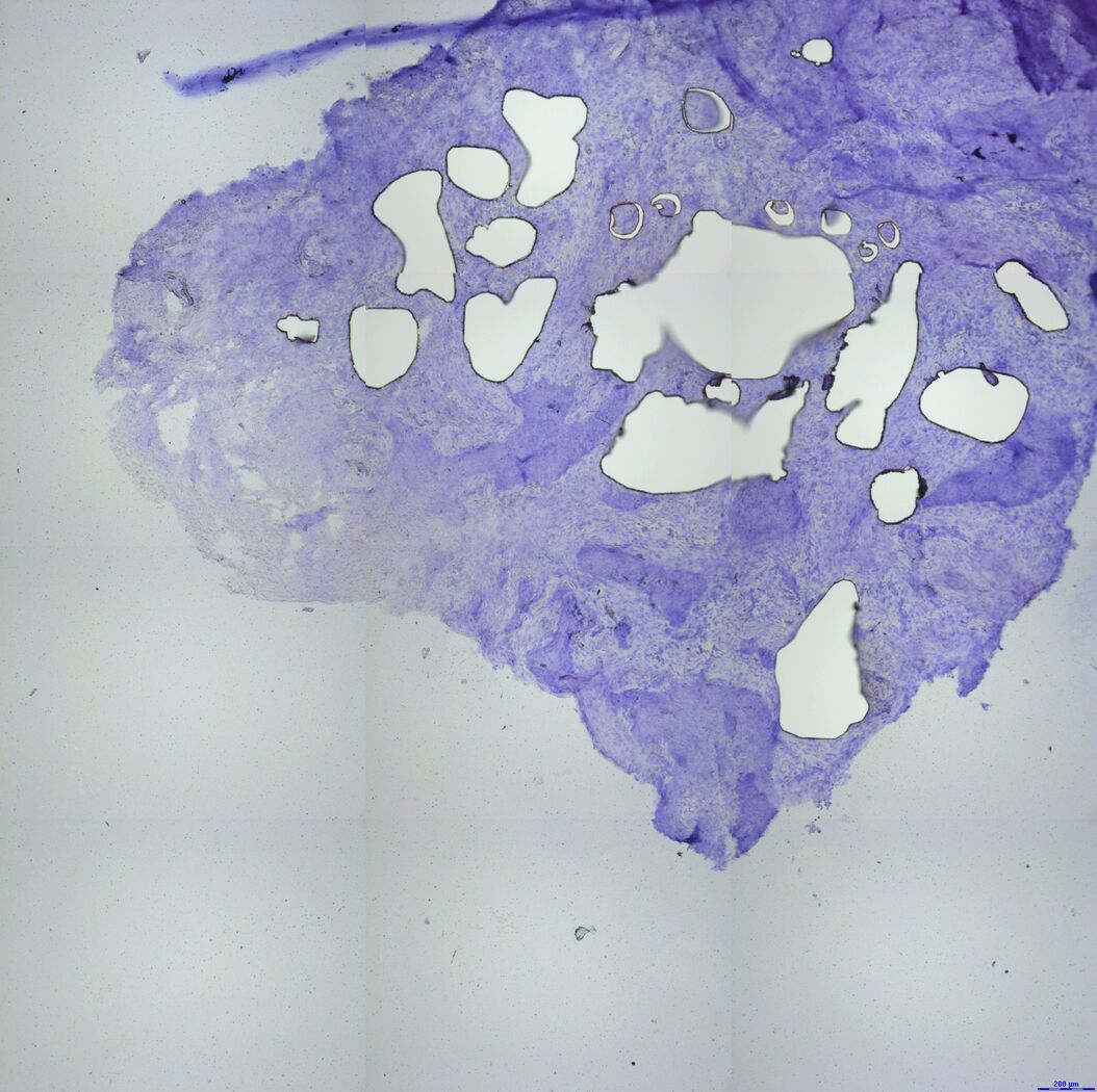Exemplary Specimen Overviews of a customer sample with many tumor areas being dissected LMD-Path-Cancer-4.jpg