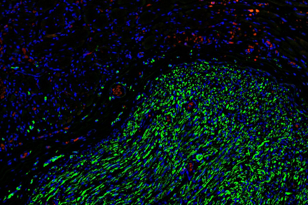 Fluorescence microscopy of sectioned tissue, showing the interface between the extensor digitorum longus muscle and the common peroneal nerve in the adult rat. Regenerative peripheral nerve interface (RPNI) at 2 weeks. Image acquired using Mica. Stained for nuclei (blue), neurofilaments (green) and S100B (red). Image courtesy of Dr. Aaron Lee, Department of Bioengineering (Lab of Dr. Rylie Green), Imperial College London. Interface_extensor_digitorum_longus_muscle_and_common_peroneal_nerve_in_adult_rat_teaser.jpg