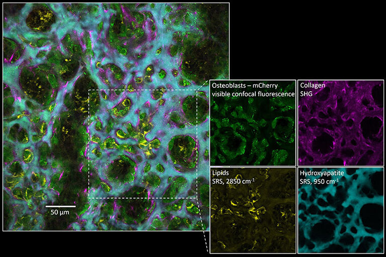 Multimodale optische Bildgebung der Osteogenese in einem Explantat einer Maus-Schädelkappe unter Verwendung einer Kombination aus sichtbarer konfokaler Fluoreszenzmikroskopie mit mehrfarbiger chemischer Bildgebung über SRS und zusätzlichem physikalischem Kontrast über SHG. In einer einzigen Probe werden die Lokalisierung von Osteoblasten, die Ablagerung extrazellulärer Kollagenfasern und die Bildung von Knochenmineralien visualisiert. Darüber hinaus werden lipidreiche Strukturen hauptsächlich in isolierten Osteoblasten beobachtet, die über die sich entwickelnden Knochenstrukturen verteilt sind. Probe mit freundlicher Genehmigung von Jacqueline Tabler und Sebastian Bundschuh, MPI-CBG Dresden.