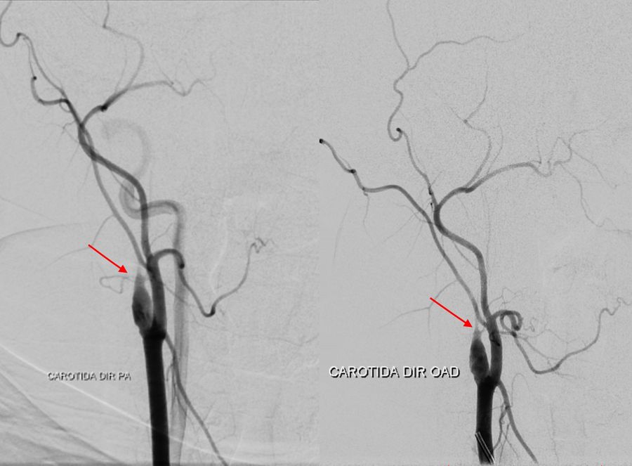 Right common carotid  angiography (PA and  oblique views) showing  occlusion at the proximal  third of the cervical  segment of the right  internal carotid artery  (showed by red arrows),  and patent branches of the  external carotid artery.