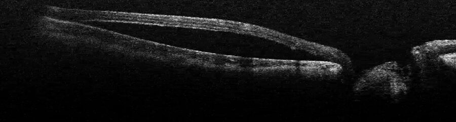 术中 OCT 显示视盘旁边的视网膜被挤压，中心凹脱离。图片由 Nikolaos Bechrakis 教授提供。
