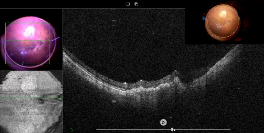 Fig. 15: The well positioned autologous RPE transplant is shown on the Ngenuity® monitor.