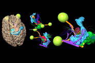 Brain tumor surgical planning leveraging Augmented Reality. Image courtesy of Prof. Philippe Bijlenga.