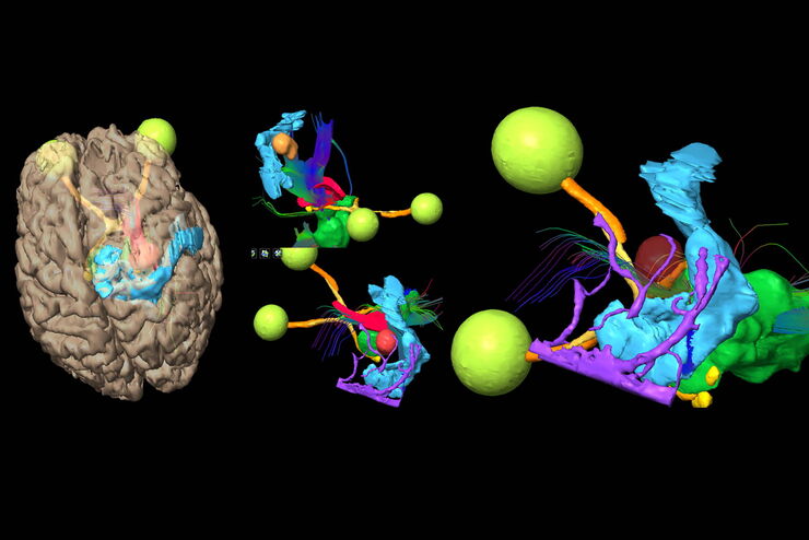 Brain tumor surgical planning leveraging Augmented Reality. Image courtesy of Prof. Philippe Bijlenga.