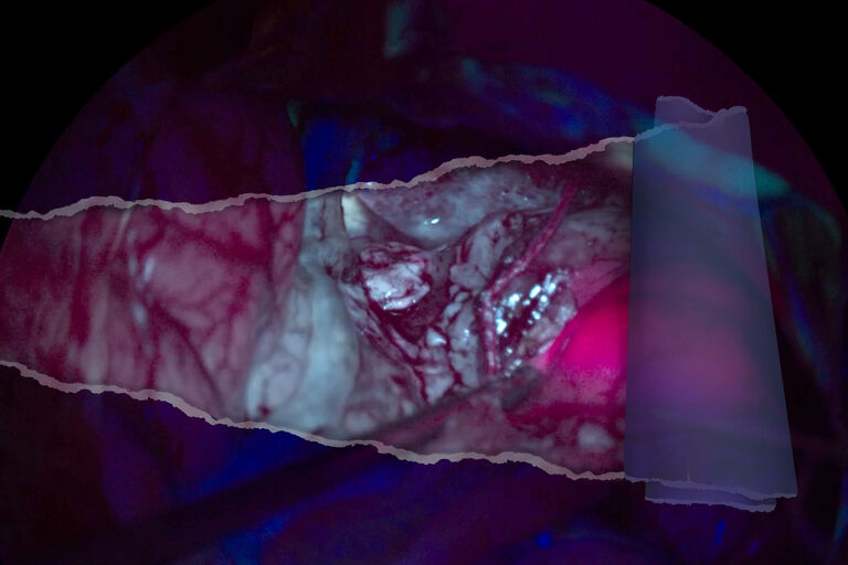 La vista Anatomy di GLOW400 migliora la visualizzazione di tumori marcati con fluorescenza e fornisce una vista più chiara dei dettagli anatomici circostanti. GLOW400, le foto sono per gentile concessione di Tim Jacquesson, MD, PhD Hospices Civils de Lyon, Francia.