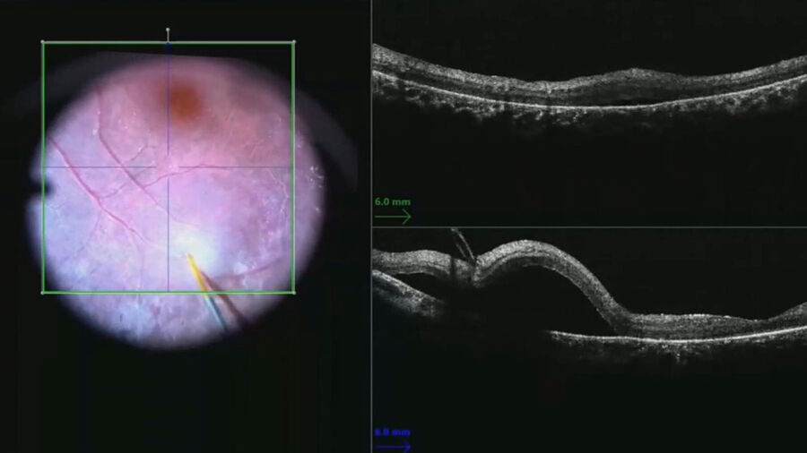 Figure 4: Foveal anatomy monitored in real time during bleb creation with intraoperative OCT. Image courtesy of Robert A. Sisk, MD, FACS, Cincinnati Eye Institute.