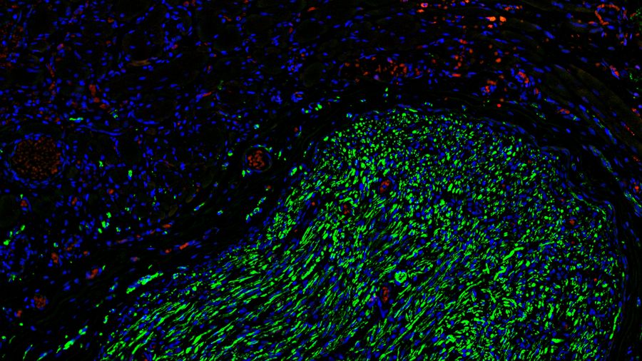 Fluorescence microscopy of sectioned tissue, showing the interface between the extensor digitorum longus muscle and the common peroneal nerve in the adult rat. Regenerative peripheral nerve interface (RPNI) at 2 weeks. Image acquired using Mica. Stained for nuclei (blue), neurofilaments (green) and S100B (red). Image courtesy of Dr. Aaron Lee, Department of Bioengineering (Lab of Dr. Rylie Green), Imperial College London.