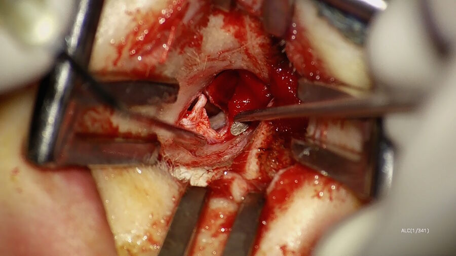 Figure 4: Elevation of the tympanomeatal flap. Image courtesy of Dr. Sean Flanagan