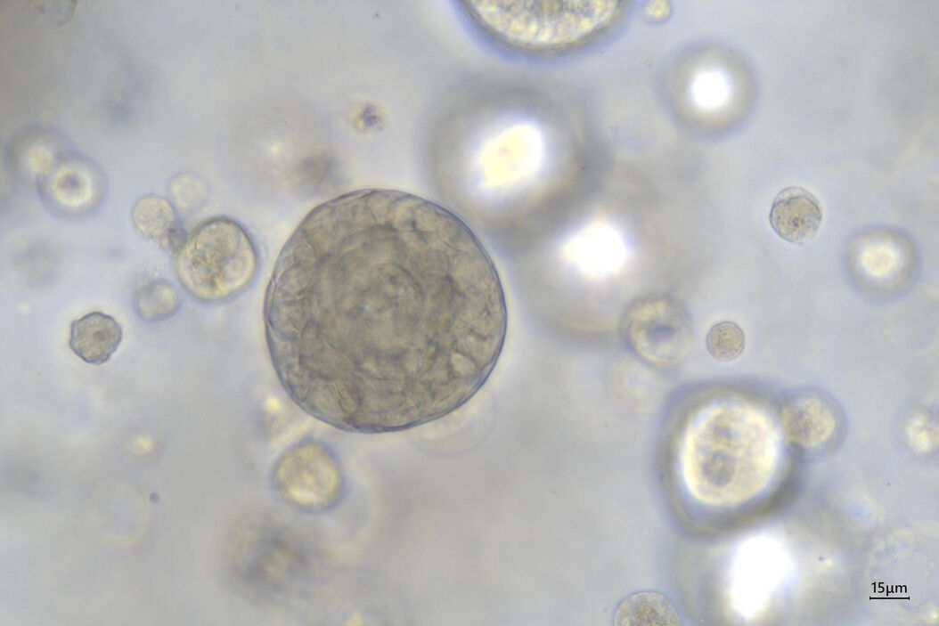 40x magnification of organoids cluster taken on Mateo TL.Cell type: esophageal squamous carcinoma; scale  bar 15µm. Courtesy of bioGenous, China.  Esophageal_squamous_carcinoma_scale__bar_15_m.jpg