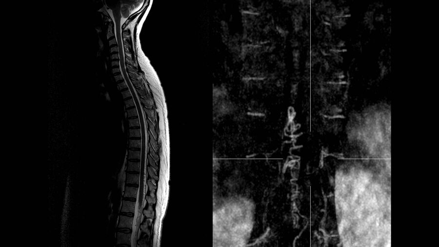 Spinal MRI of a patient with a spinal arterio-venous fistula. Image courtesy of Dr. Charlotte Flueh.