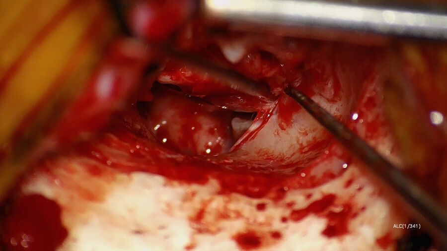 Figure 2: Identification of the chorda tympani nerve. Image courtesy of Dr. Sean Flanagan