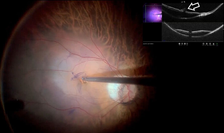 Fig. 5: The same patient as depicted in Figs. 2 and 3 with high myopia-associated macular hole and retinal detachment. The white arrow shows an inverted ILM flap placed above the macular hole.