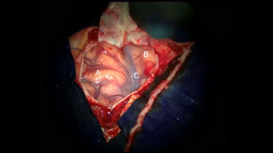 A pterional craniotomy was performed, exposing the frontal Inferior  gyrus (A), the superior temporal gyrus (B) and the Silvian fissure (C).