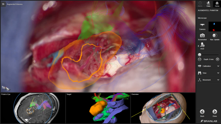 Neurochirurgie mit CaptiView Bildeinspiegelung und der Neuronavigationssoftware Cranial 1.5 von Brainlab.