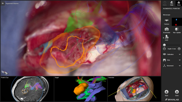 Neurocirurgia realizada com um microscópio cirúrgico M530 OH6, CaptiView e software de neuronavegação cranial 1.5 da Brainlab