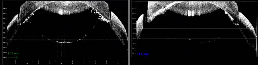 Figure 4: The intraoperative OCT allows the surgeon to analyze the thickness of the cornea at all degrees. Image courtesy of Prof. Fontana.