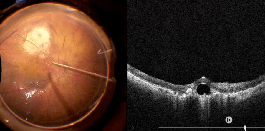 Fig. 14: The intraoperative OCT scan performed with EnFocus revealed a PFCL bubble on the inferior edge at the margin of the patch. Since the presence of the PFCL bubble and hemorrhage are risk factors for failure of the procedure, we decided to remove the bubble. The PFCL above the retina was aspirated: the temporal retina was folded again and the subretinal PFCL at the border of the patch was then aspirated. Subsequently, the retina was replaced using PFCL.