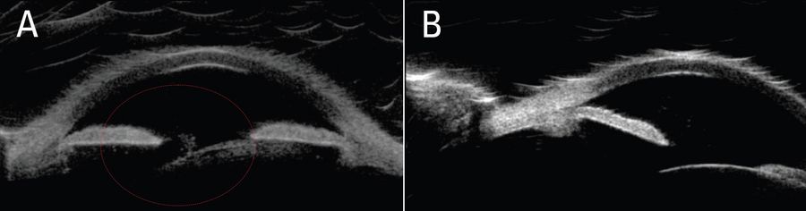 Pre-operative intraoperative OCT scans revealed a tuft of vitreous in the anterior chamber (A) and a severely tilted lens (B). Image courtesy of Arsham Sheybani, MD, Washington University School of Medicine.