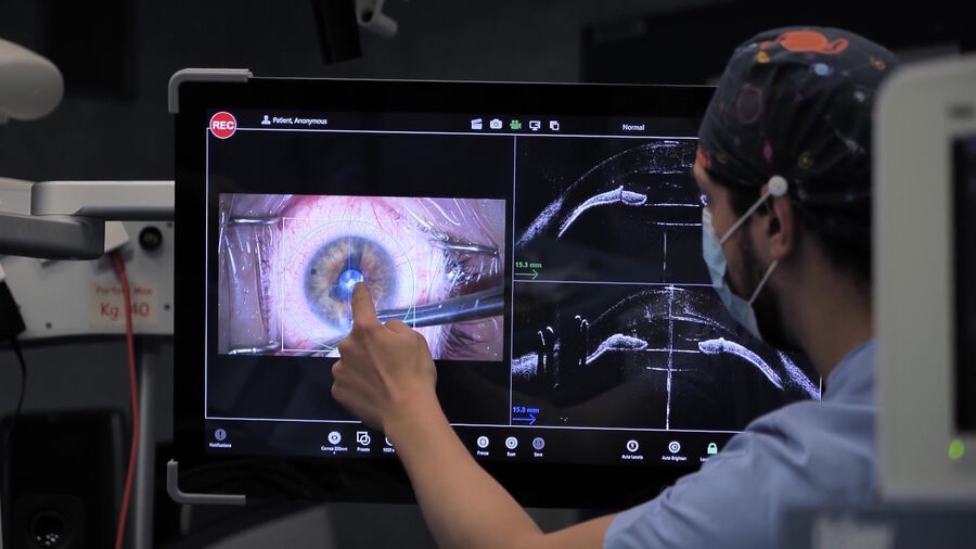 Figure 3: Intraoperative OCT view of the cornea in its entire thickness as well as the anterior chamber. Image courtesy of Prof. Fontana.